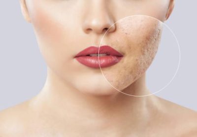 A young girl with a problem skin. Photo before and after treatment for acne.