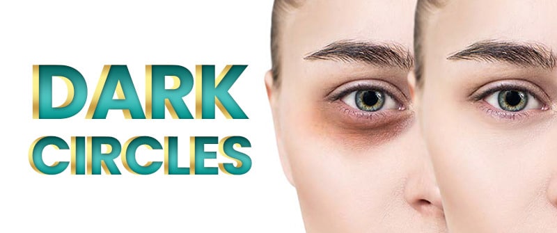 Dark Circles Under Eyes Causes and Treatment- Rehman Medical Center