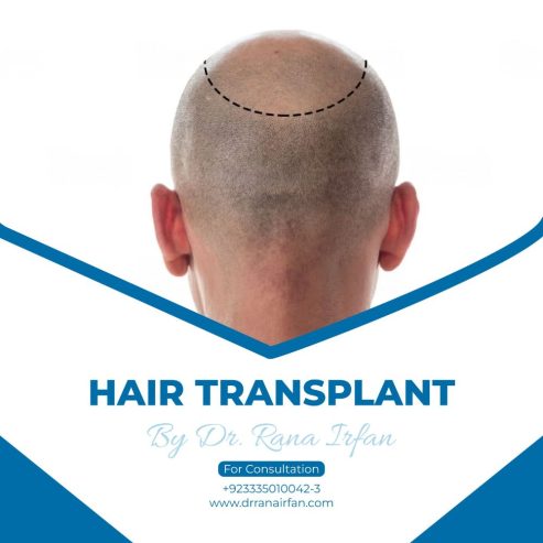 Hair restoration services in islamabad Pakistan