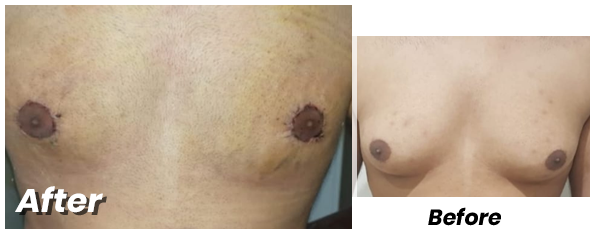 Leading Gynecomastia Surgery in Lahore