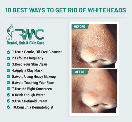 Get Rid of Whiteheads – Whiteheads Removal