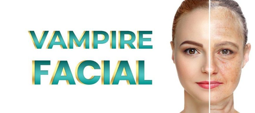 Vampire Facelift – vampire facial – facial PRP