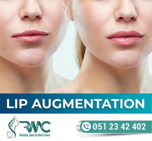 Lip Filler Treatment in Islamabad