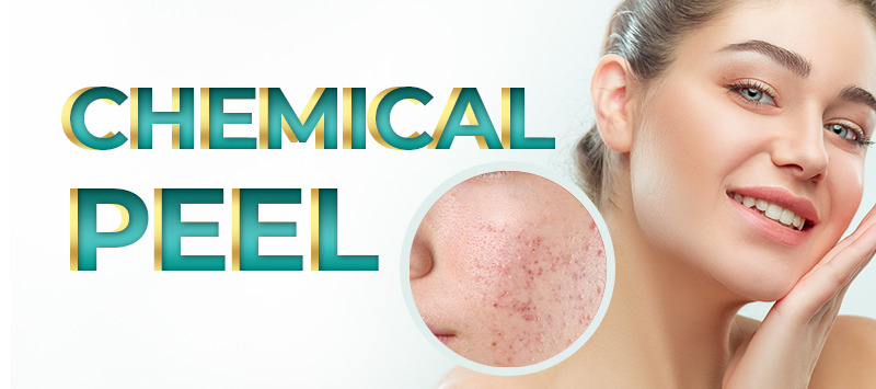 Chemical peel Treatment in Islamabad – Rehman Medical Center