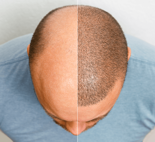 Hair Transplant Islamabad