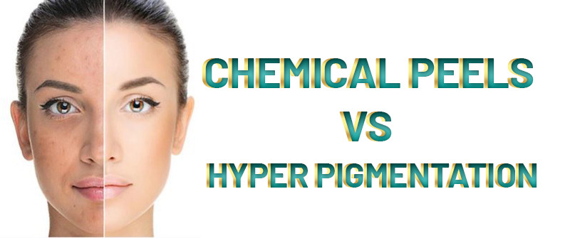 Chemical peel for Acne and Hyperpigmentation in Islamabad – R M C
