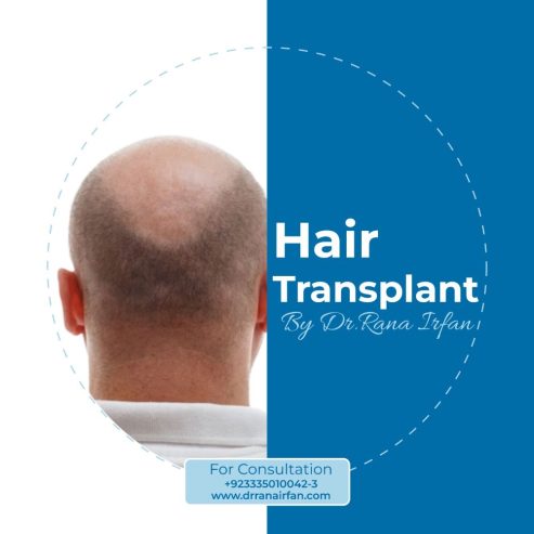 Hair restoration treatment in Islamabad Pakistan
