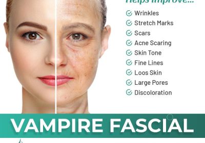 Vampire Facial Treatment -Rehman Medical Center +92 51 23 42 402