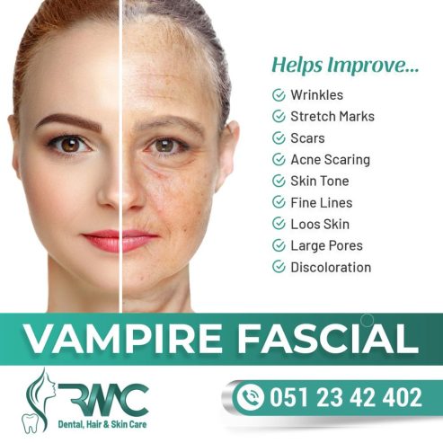 Vampire Facial Treatment