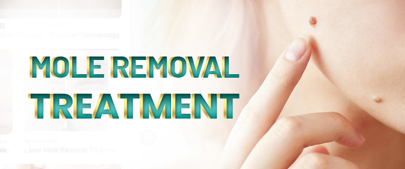 Laser Mole Removal in Islamabad – Rehman Medical Center