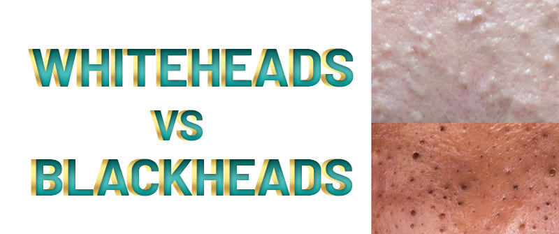 White and Blackheads Removal in Islamabad – Rehman Medical Center